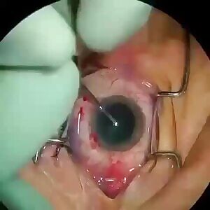 Cataract removal
