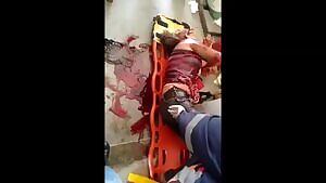 Spilled Intestines In Stretcher