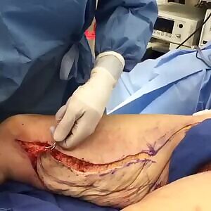 Is this the correct way to remove skin?!