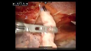 Removing a bullet lodged against the ascending aorta.