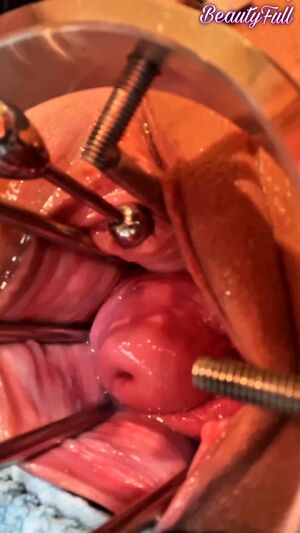 Stuffed Pussy Anal Speculum Extreme Gyno