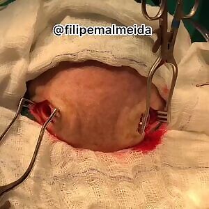 Chronic Subdural Hematoma