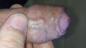 Removing my foreskin, close view