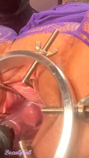 Stuffed Pussy Anal Speculum Extreme Prolapse