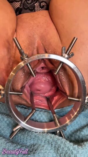 Gaping Anal Speculum Extreme Gape Prolapse